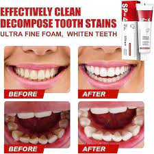 🌟SP-4 Probiotic Intensive Teeth 🦷✨ Whitening Toothpaste 😁 🤩💥SALE FLAT 50% OFF💥🤩